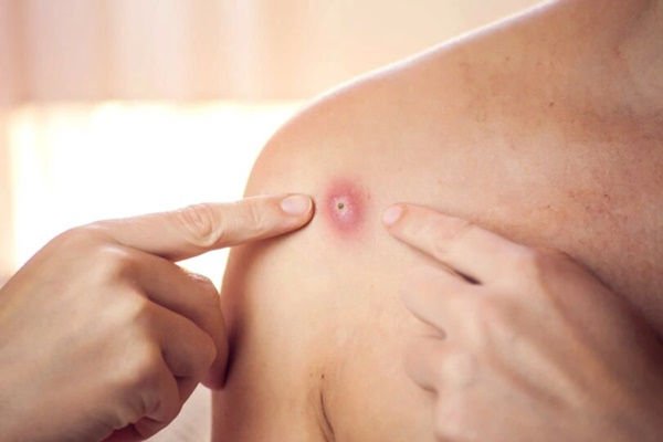 Đậu mùa khỉ ảnh hưởng thế nào đến sức khỏe sinh sản và tình dục?