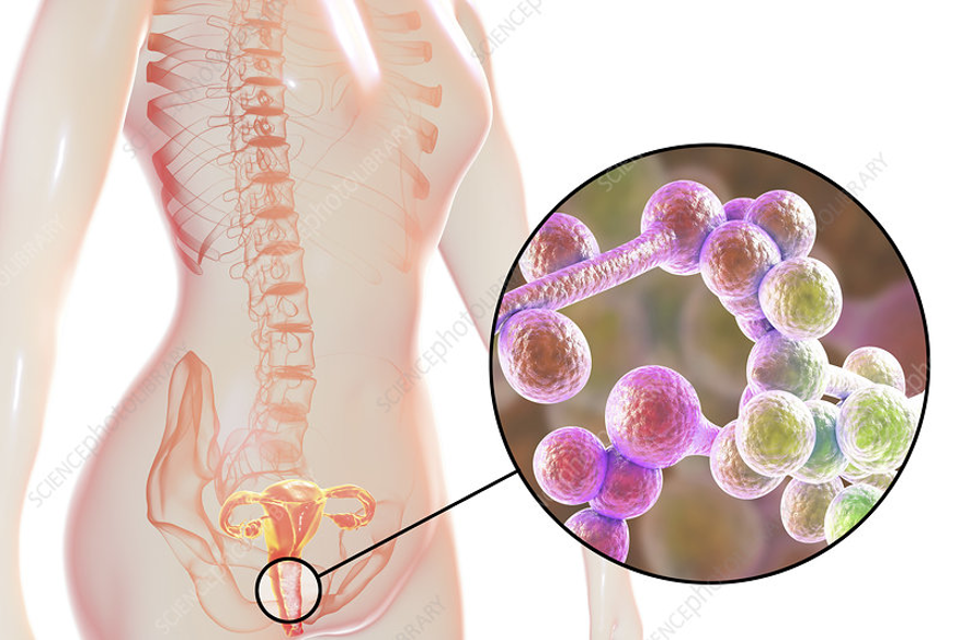 How does vaginal yeast infection affect reproductive health?