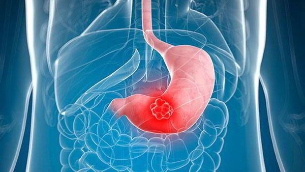 Food not for people with stomach ulcers