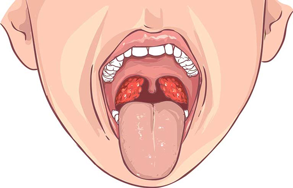 Are mouth ulcers really serious?