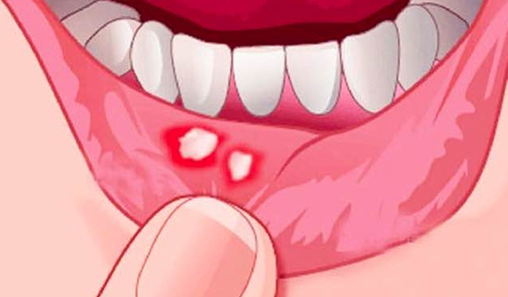 Solutions for the care and prevention of stomatitis