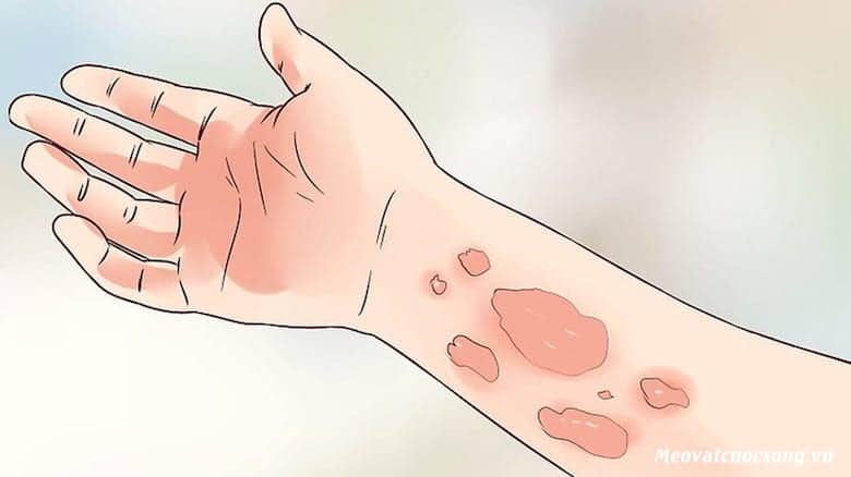 Urticaria, how to cure?