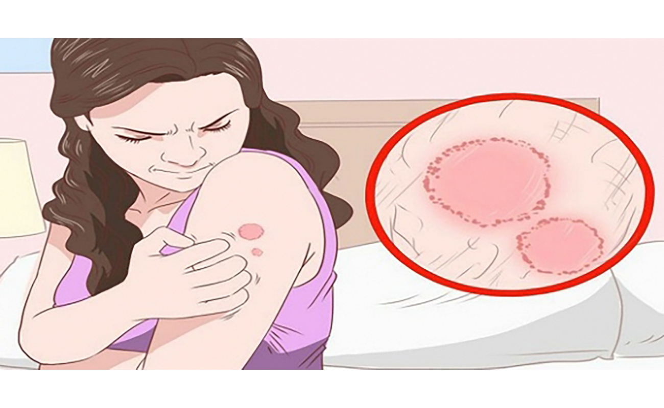 Some common common fungal skin diseases