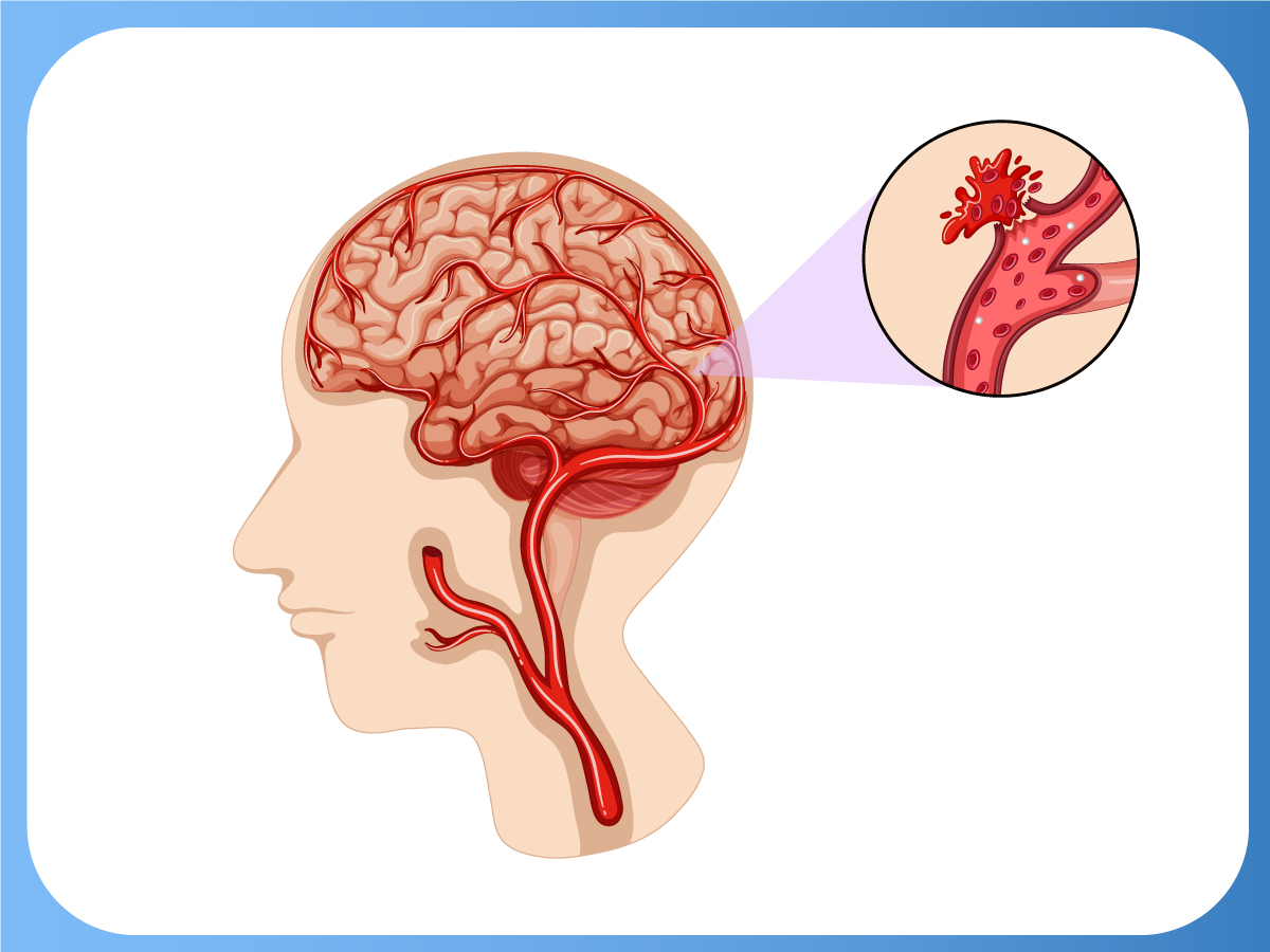 Đột quỵ và những điều bạn cần biết
